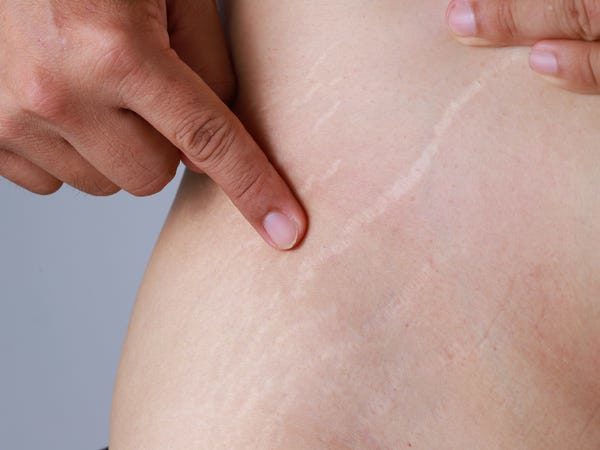 stretch marks sering terjadi pada wanita yang sedang hamil