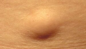 lipoma jadi salah satu penyebab benjolan di ketiak
